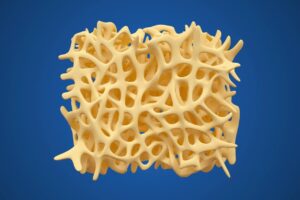 Qu'est-ce que l'ostéoporose et comment s'en protéger ?  –